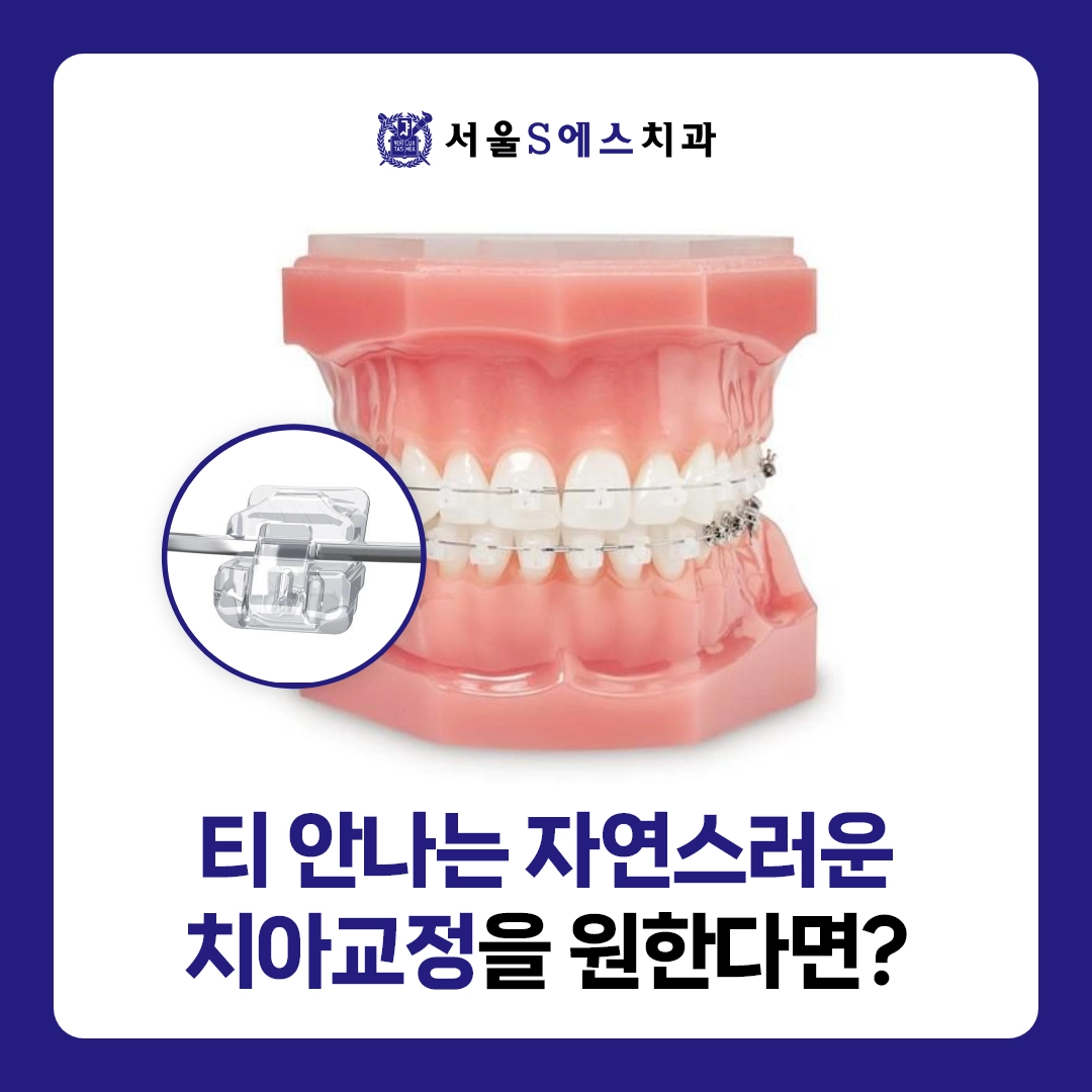 김포 장기동치과 티 안나는 자연스러운 치아교정