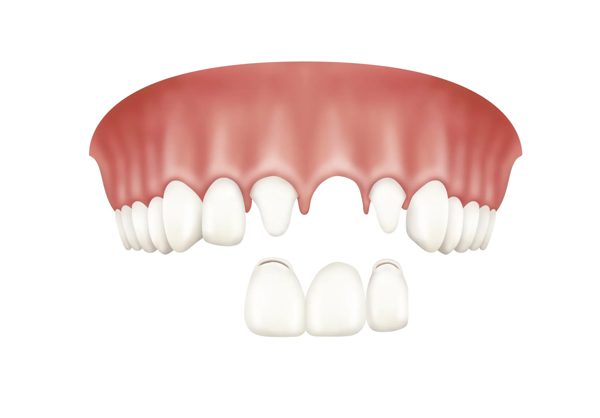 장기동치과 앞니 성형: 라미네이트 vs 올세라믹 특징 및 선택 가이드