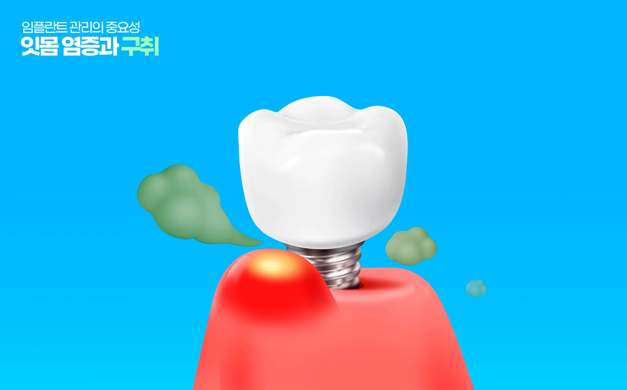 김포치과 임플란트 주위염 예방, 평생 쓰는 치아 관리의 핵심!