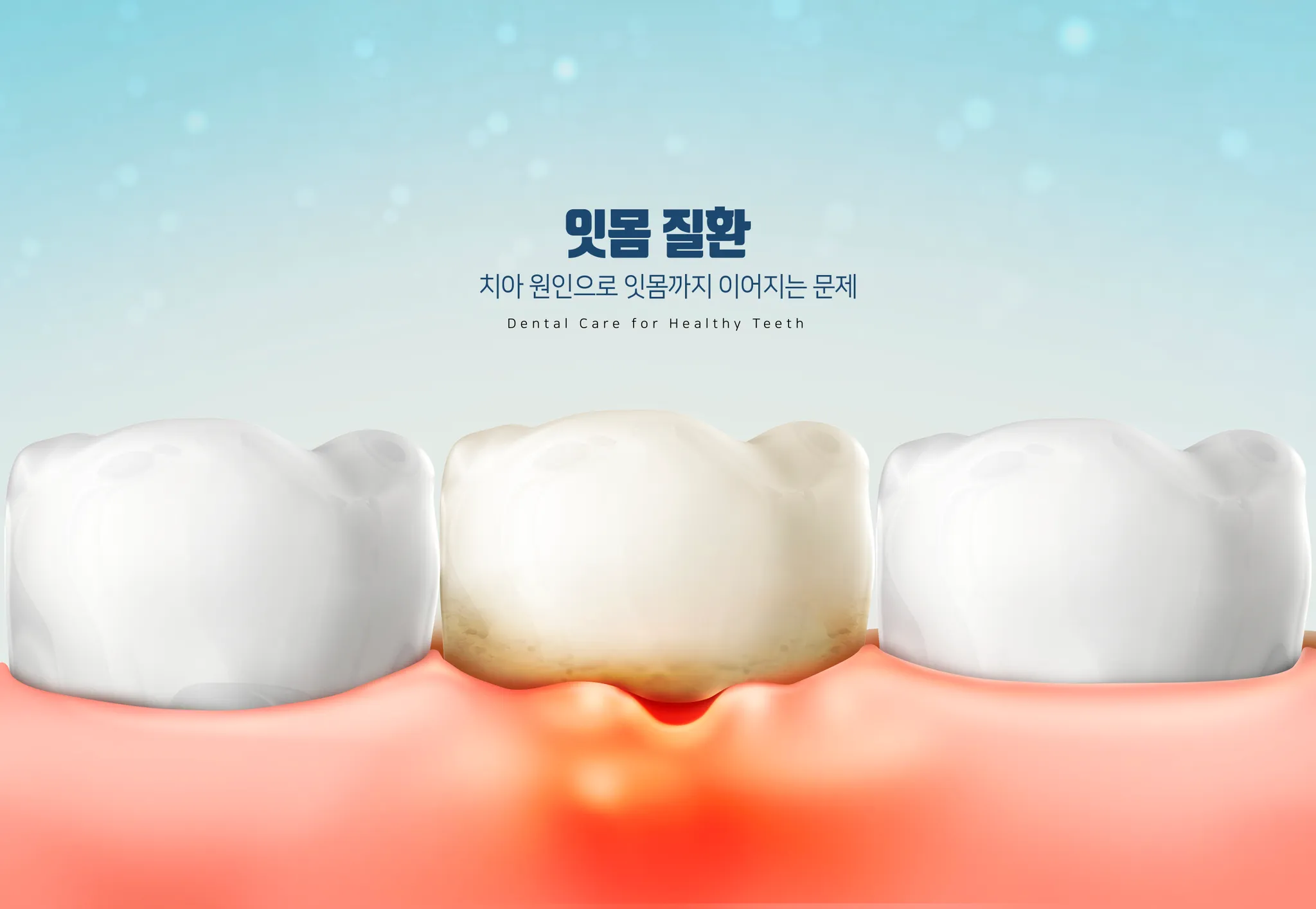김포치과 잇몸치료 왜 중요할까? 치주질환 초기 증상과 관리 방법