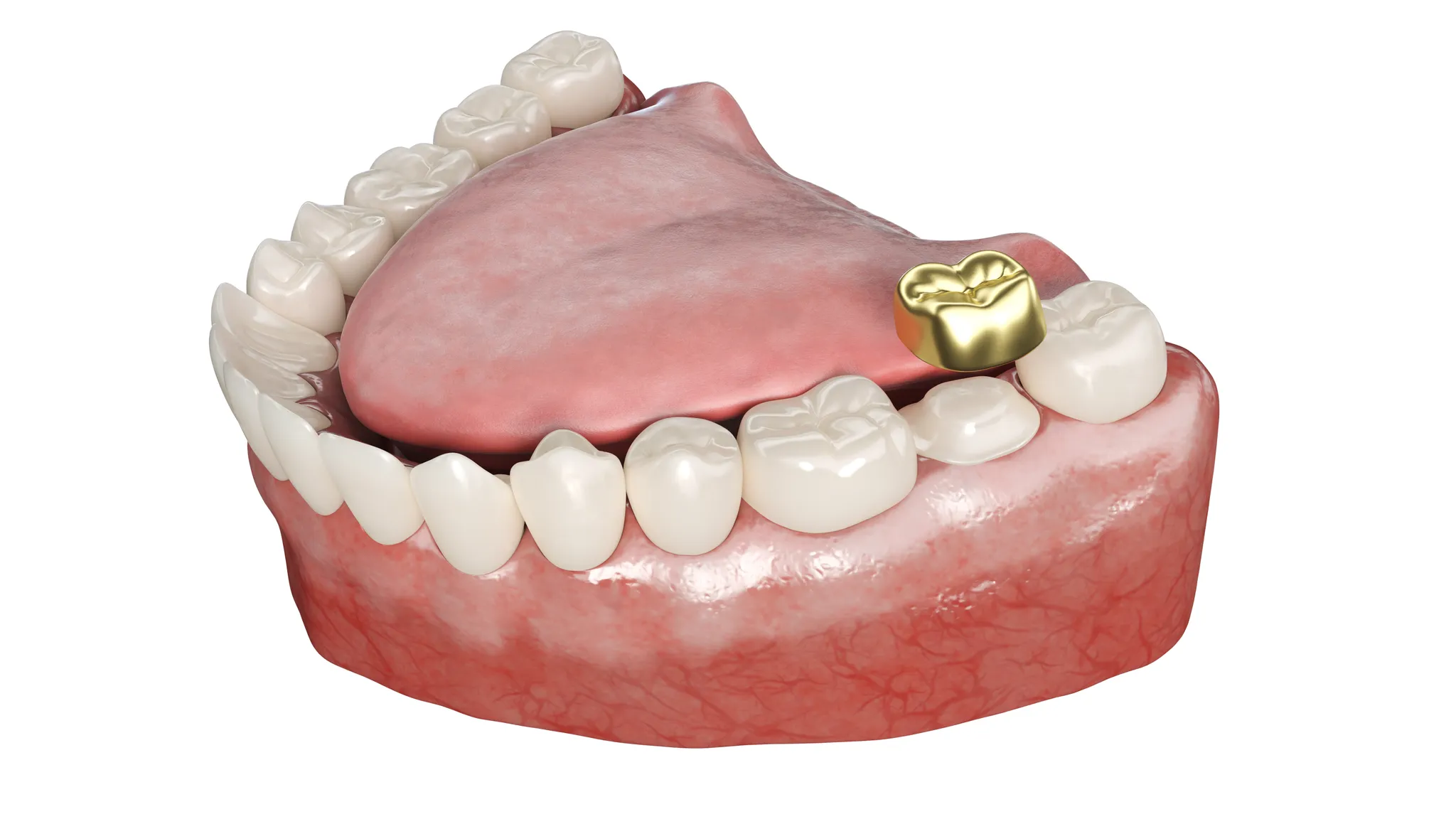 김포치과 신경치료 후 크라운 꼭 해야 할까? 안 하면 생기는 문제