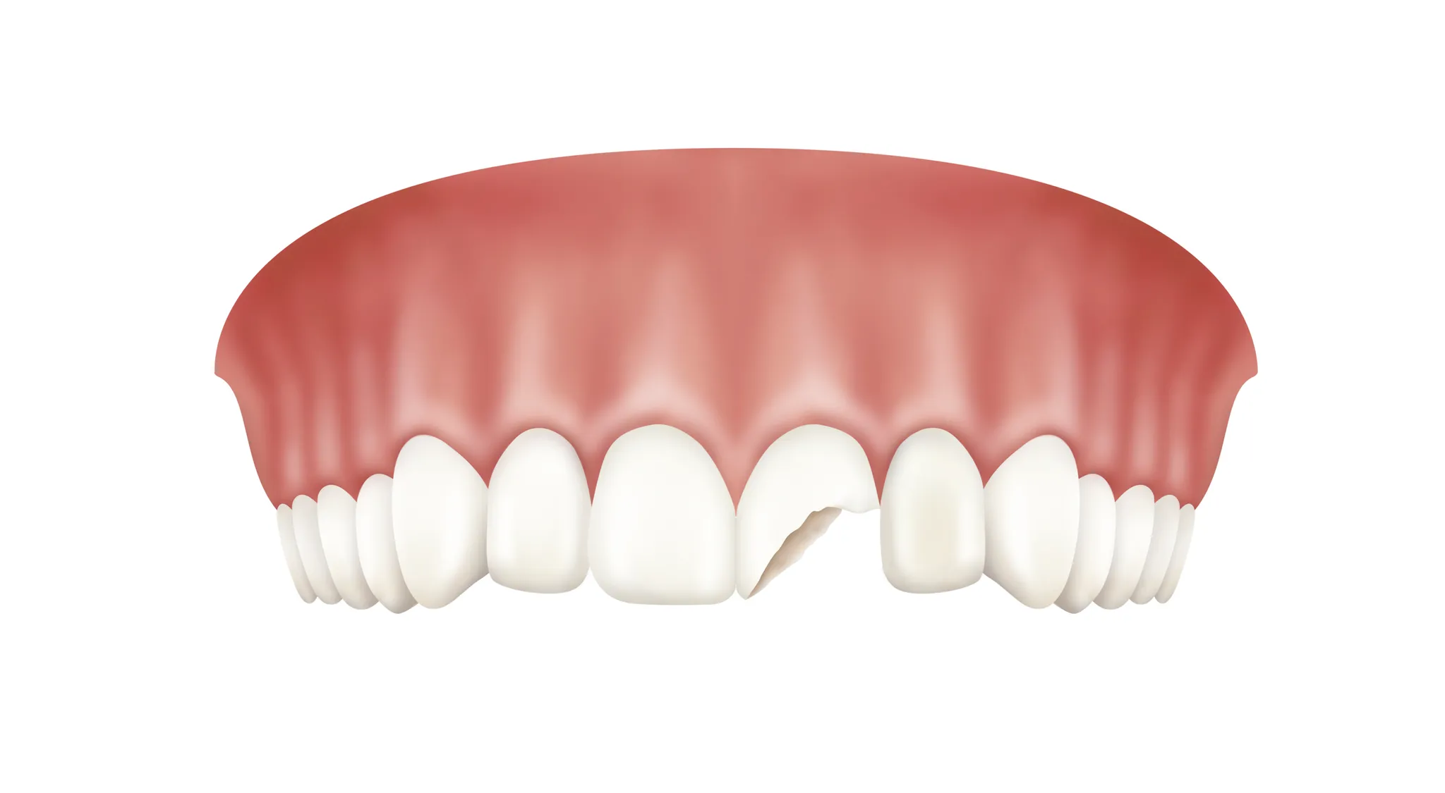 김포치과에서 알려주는 앞니 깨졌을 때 대처 방법과 치료 과정