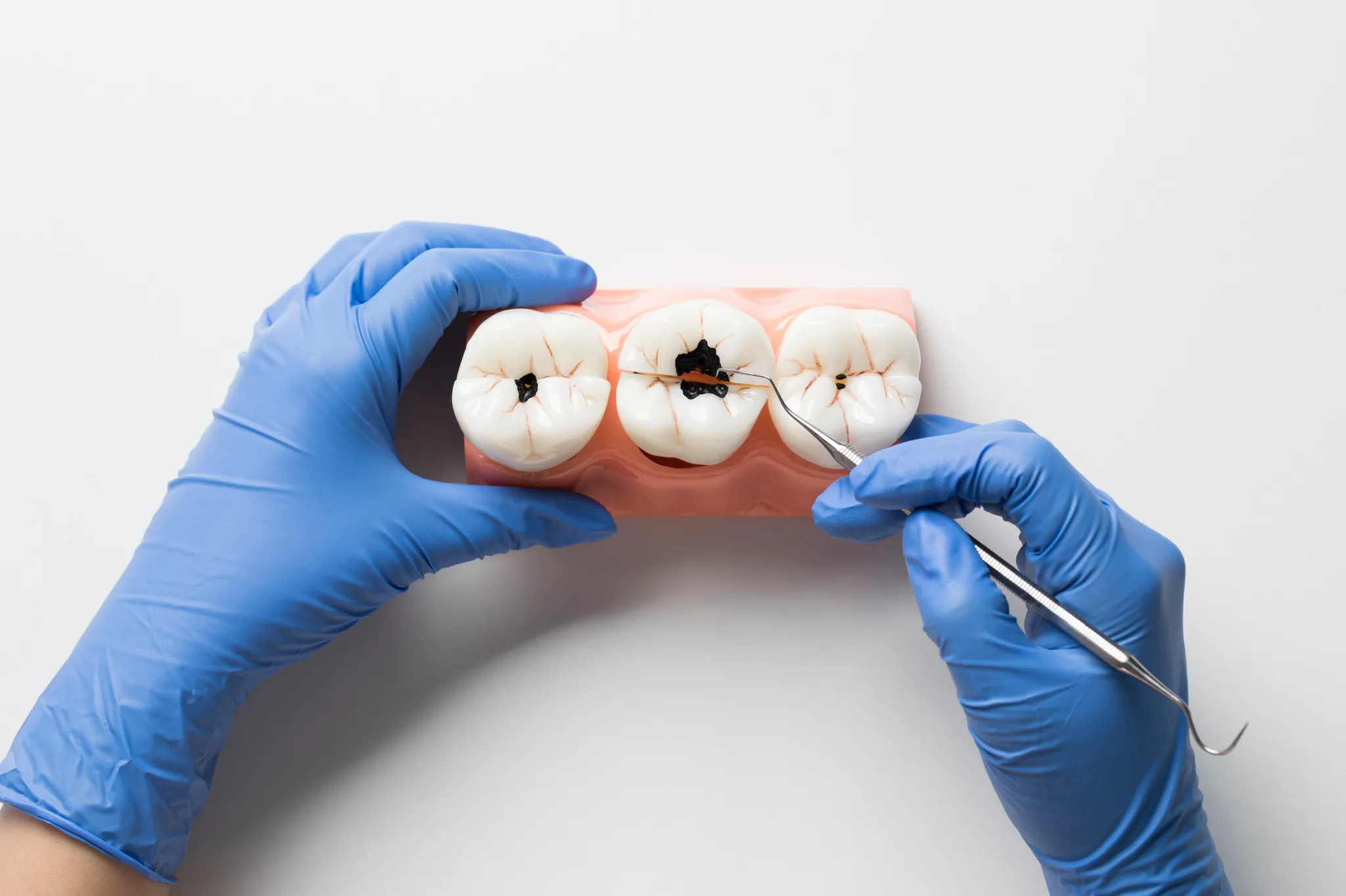 김포치과에서 알려주는 충치 치료 단계별 과정 총정리