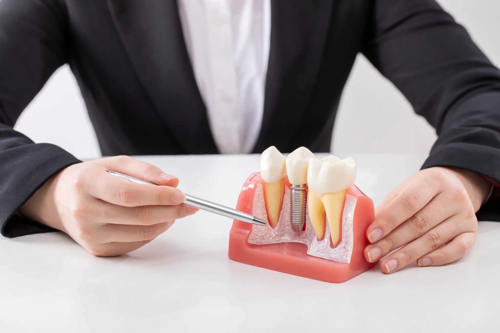 김포치과에서 알려주는 임플란트 수명 얼마나 갈까