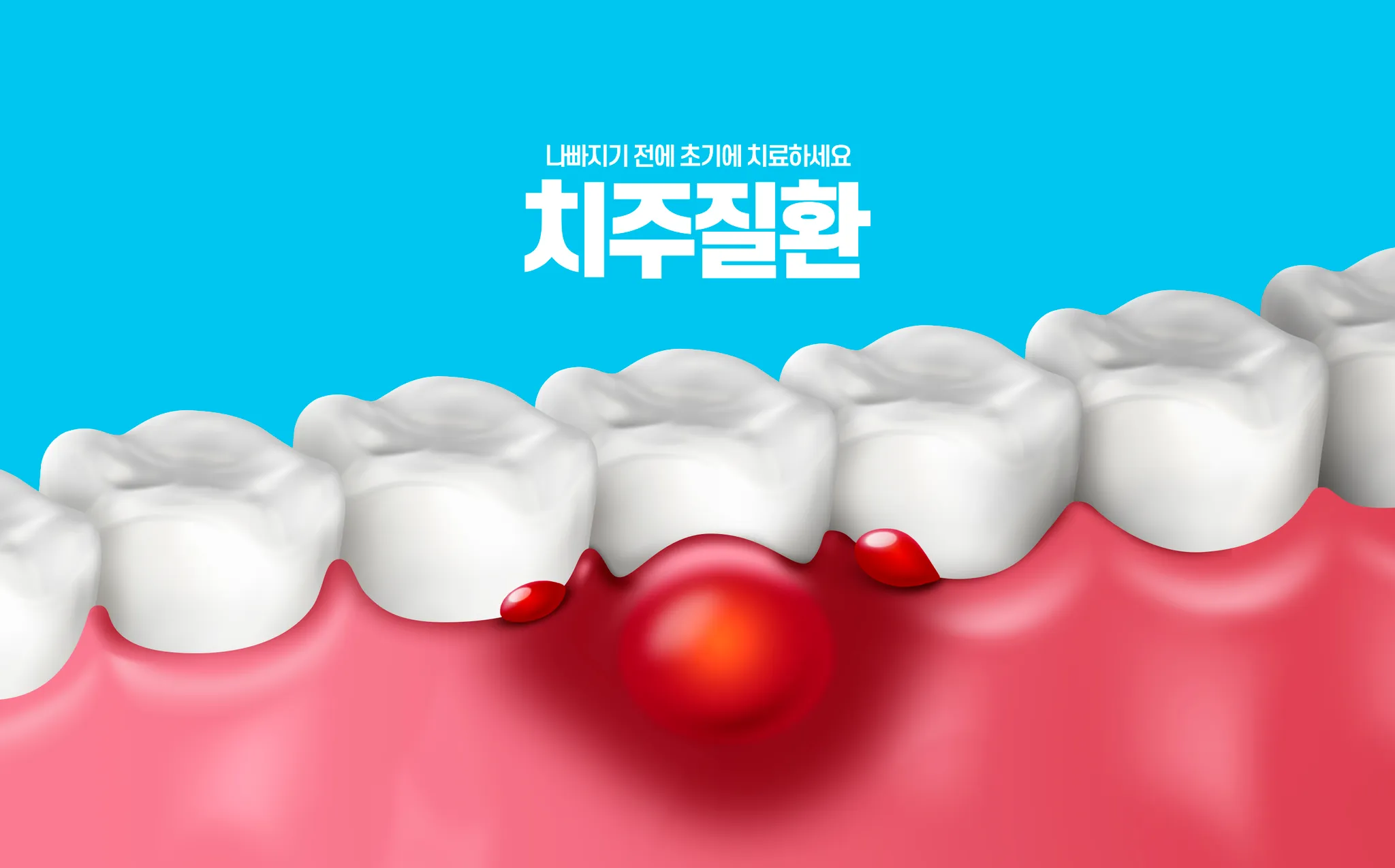 김포치과추천, 잇몸에서 피가 난다면 치주질환을 의심해야 하는 이유