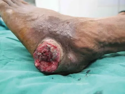 Marjolin's ulcer causes, symptoms, diagnosis, treatment & prognosis