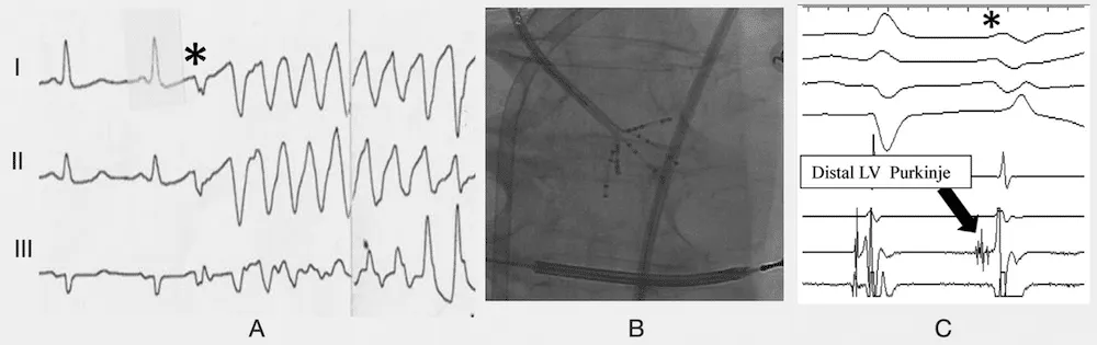 Purkinje activity in distal left posterior fascicle