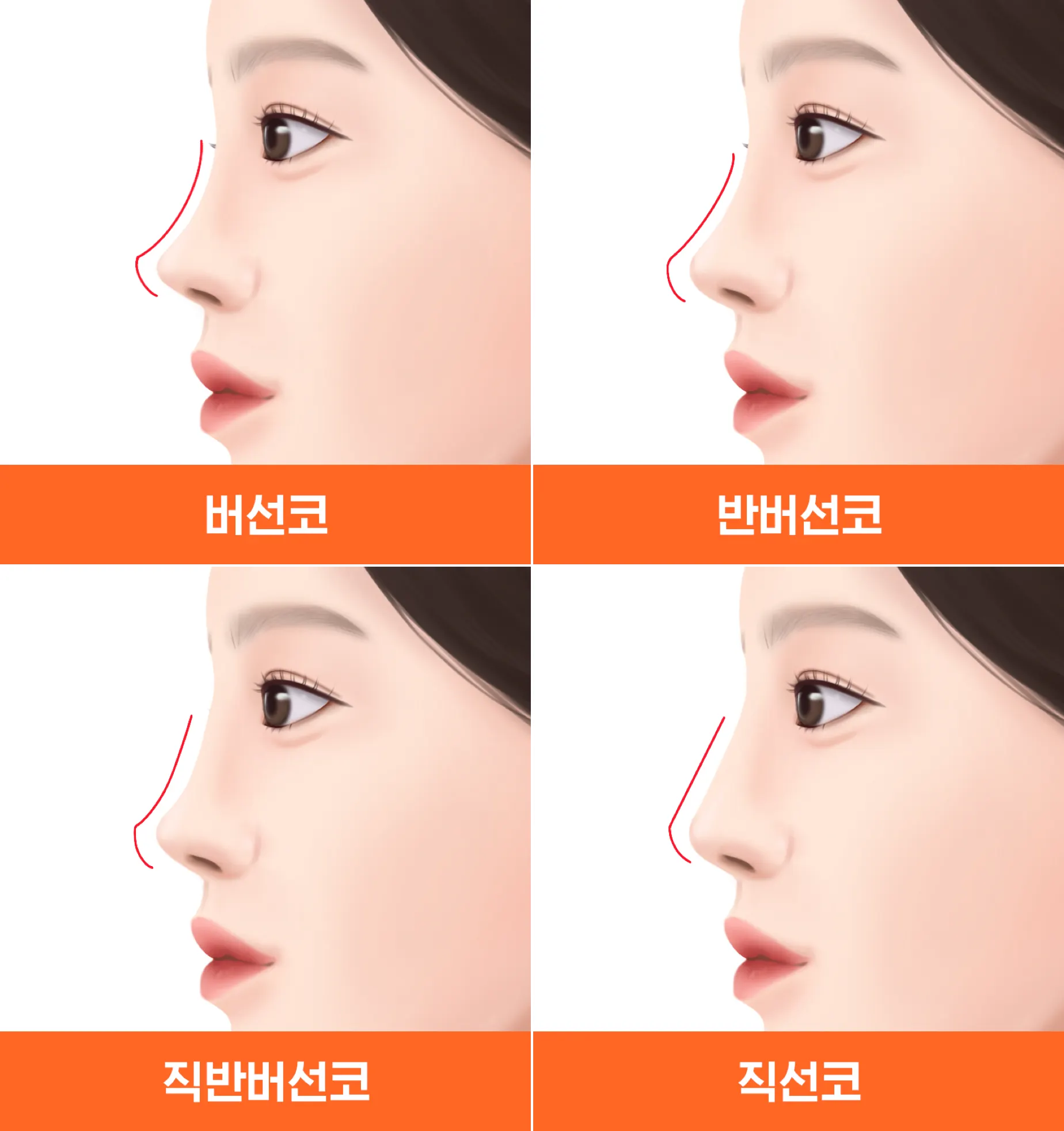 부리코 수술 3주차 옆얼굴 미인!(직반 보성코)리뷰 부리코 수술 3주차 옆얼굴 미인!(직반 보성코)리뷰